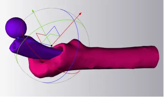Digital Surgical Planning