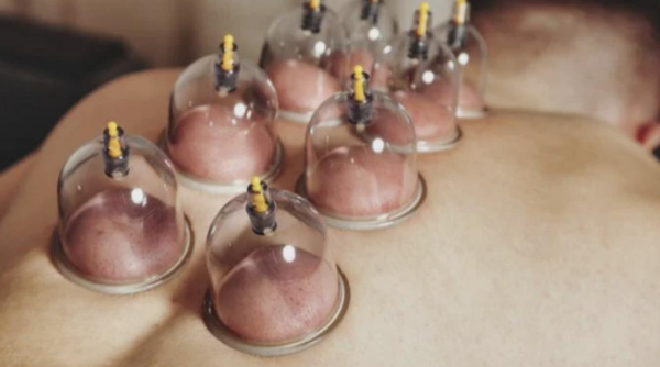 Multiple cupping therapy cups applied to a client’s back during a massage at ViyUla Beauty Spa in Darwin, aimed at boosting circulation and relieving muscle tension.