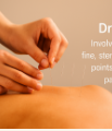 Dry Needling Darwin